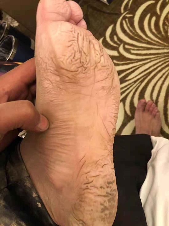 在泥濘環(huán)境中工作4天，監(jiān)測(cè)員尼布的腳浮腫變形。昌都市水文局圖