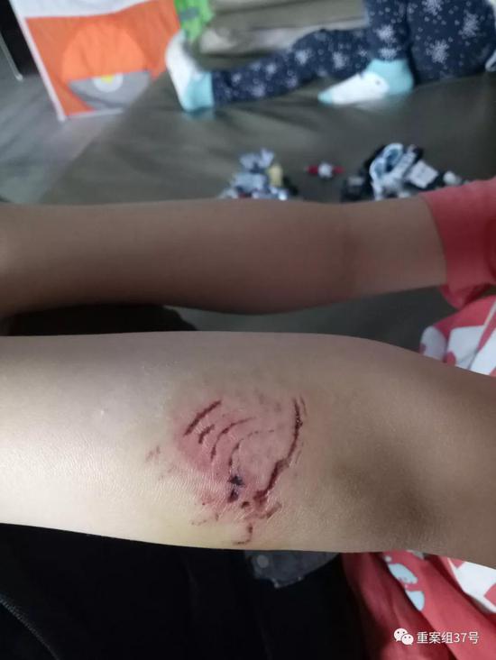 ▲另一名被咬傷5歲男孩的傷口。 &nbsp;&nbsp; 受訪者供圖